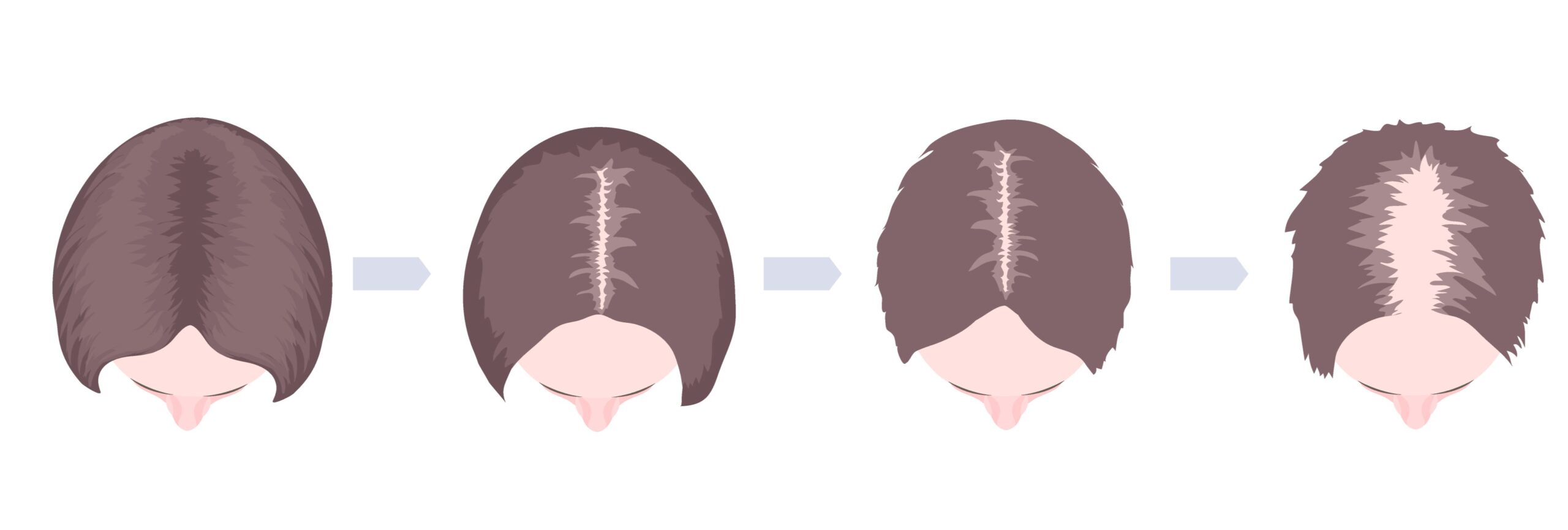 薄毛・抜け毛は頭皮全体に見られます。