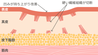 サブシジョンの説明
