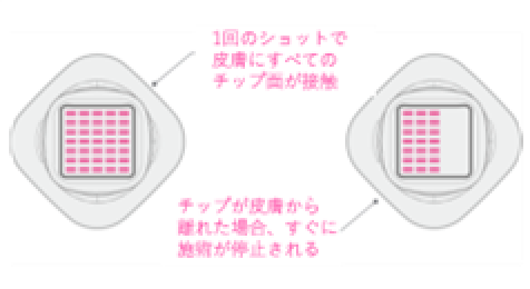 チップ