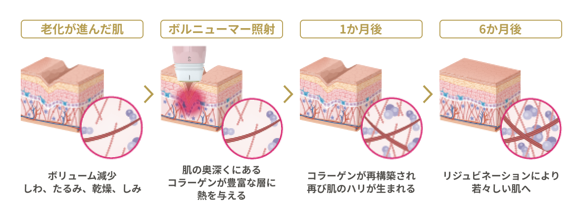 ボルニューマのメカニズム
